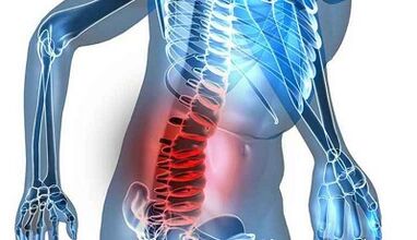 Lumbar osteokondrosiaren seinaleak eta sintomak